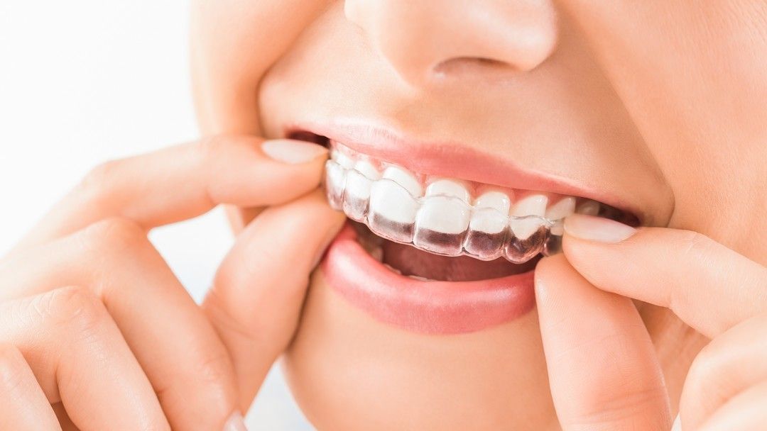 Braces Cost  North Sydney Dentistry