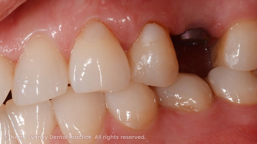north-sydney-dental-practice-dr-hargreave-real-results-individual-condition-0001-implant-side-01