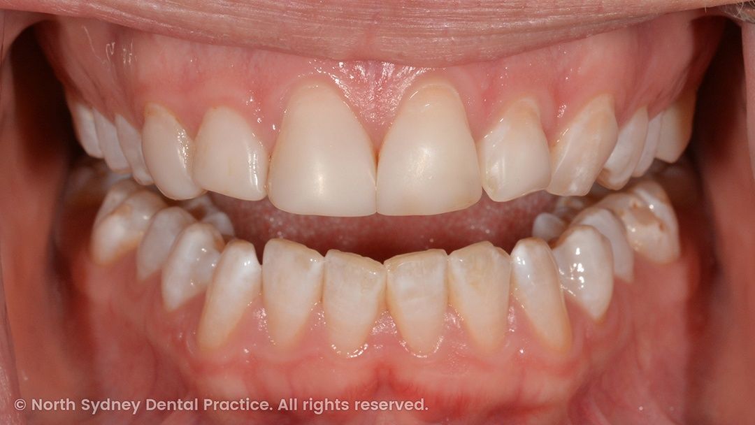 north-sydney-dental-practice-dr-hargreave-real-results-individual-condition-6022-dental-veneers-01