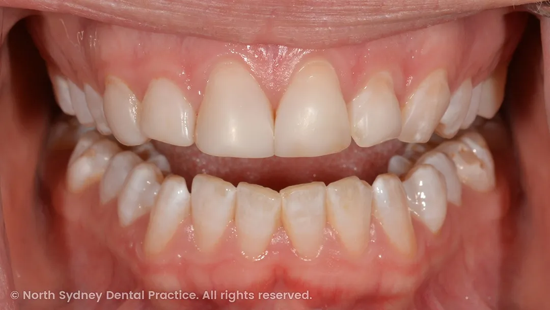 north-sydney-dental-practice-dr-hargreave-real-results-individual-condition-6022-dental-veneers-01