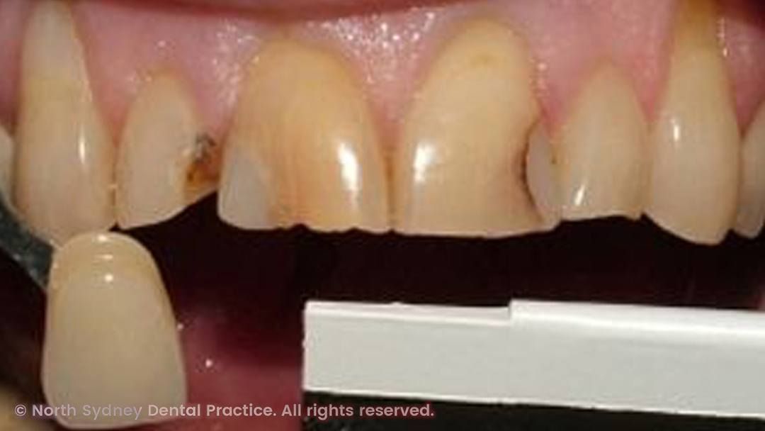 north-sydney-dental-practice-dental-crown-02