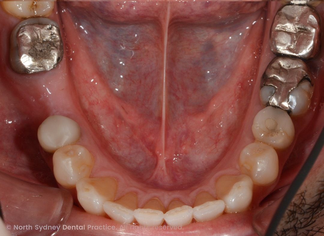 north-sydney-dental-practice-zirconia-crowns-01