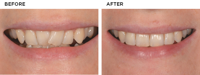 invisalign-before-after-small-1