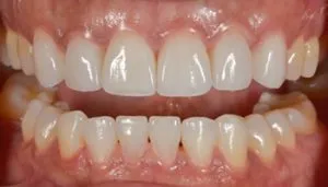 veneers before and after