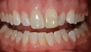 veneers before and after