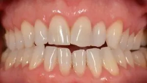 veneers before and after