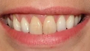 veneers before and after