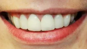 veneers before and after