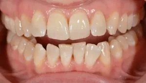 veneers before and after