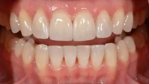 veneers before and after