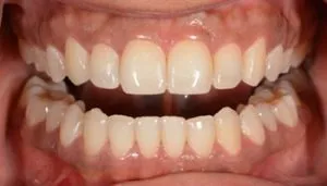 veneers before and after