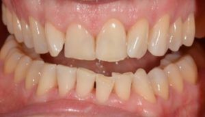 veneers before and after