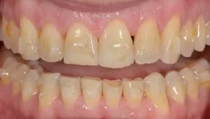 veneers before and after