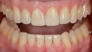 veneers before and after