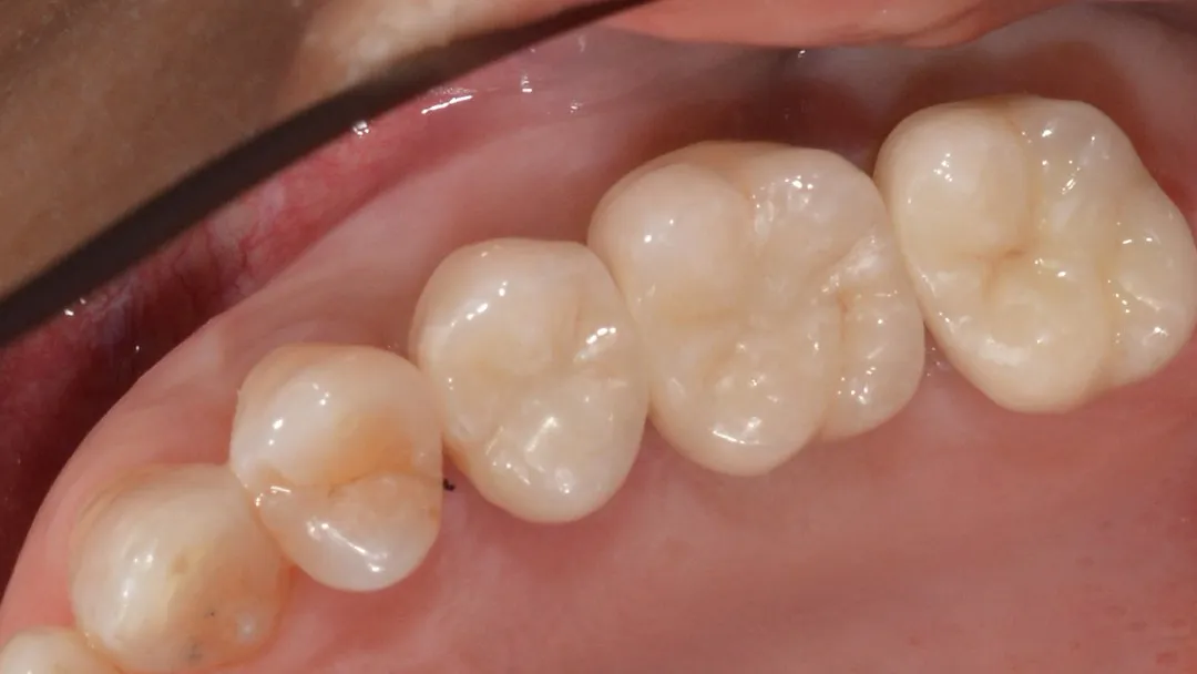 Implant and Cerec After