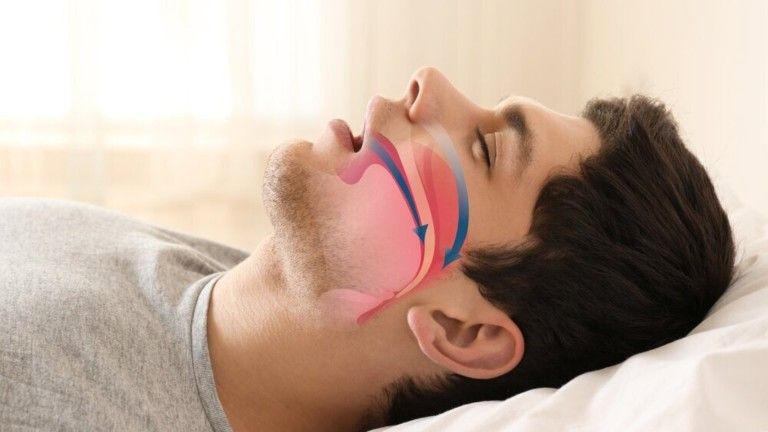 NSDP Treating sleep apnea