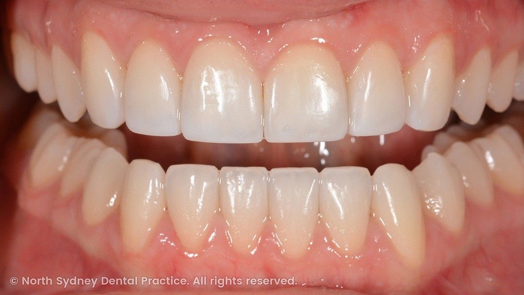 north-sydney-dental-practice-dr-hargreave-real-results-individual-condition-6990-composites-02x