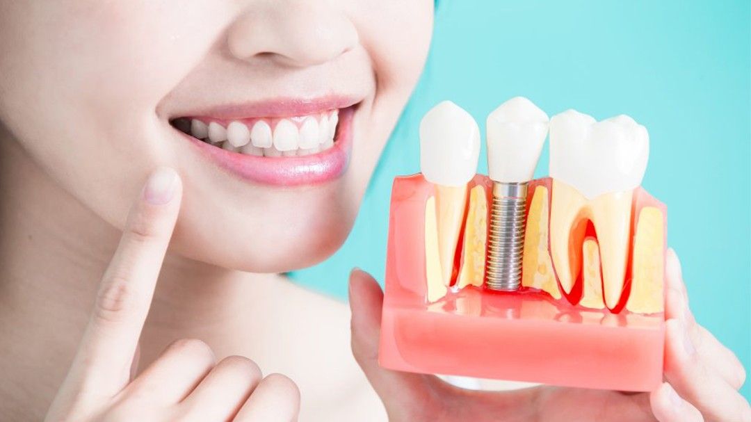 What are the different types of dental implants