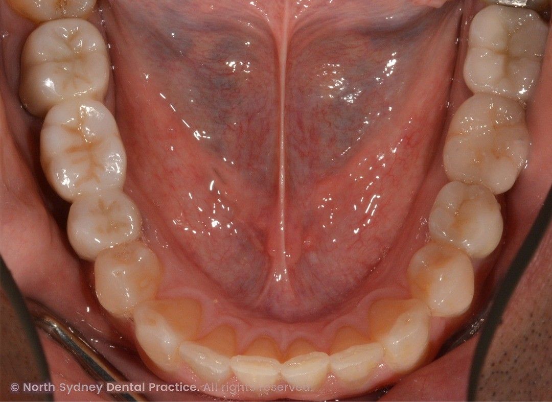 north-sydney-dental-practice-zirconia-crowns-02