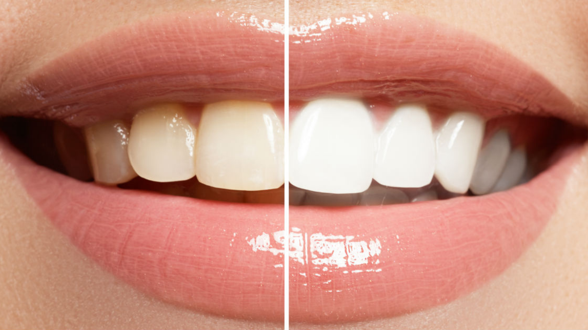 Is teeth whitening safe? - North Sydney Dental Practice