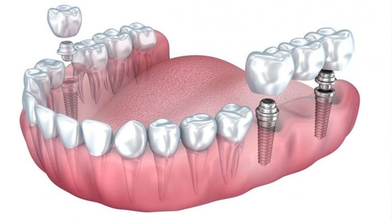 Should I choose dental bridge or dental implants