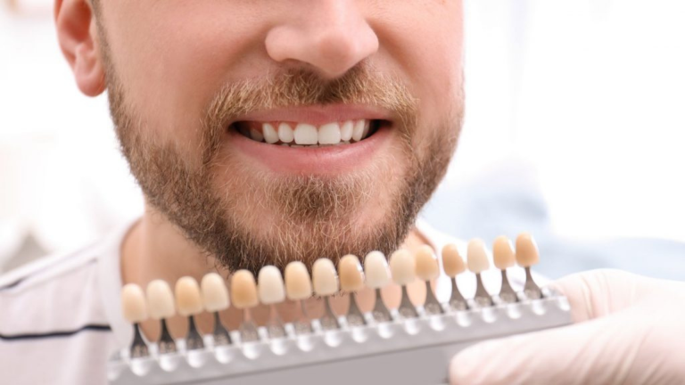 How long does professional teeth whitening last