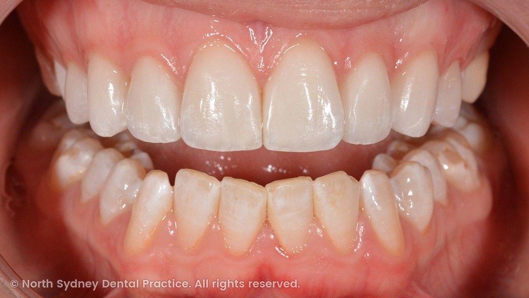 north-sydney-dental-practice-dr-hargreave-real-results-individual-condition-6022-dental-veneers-02
