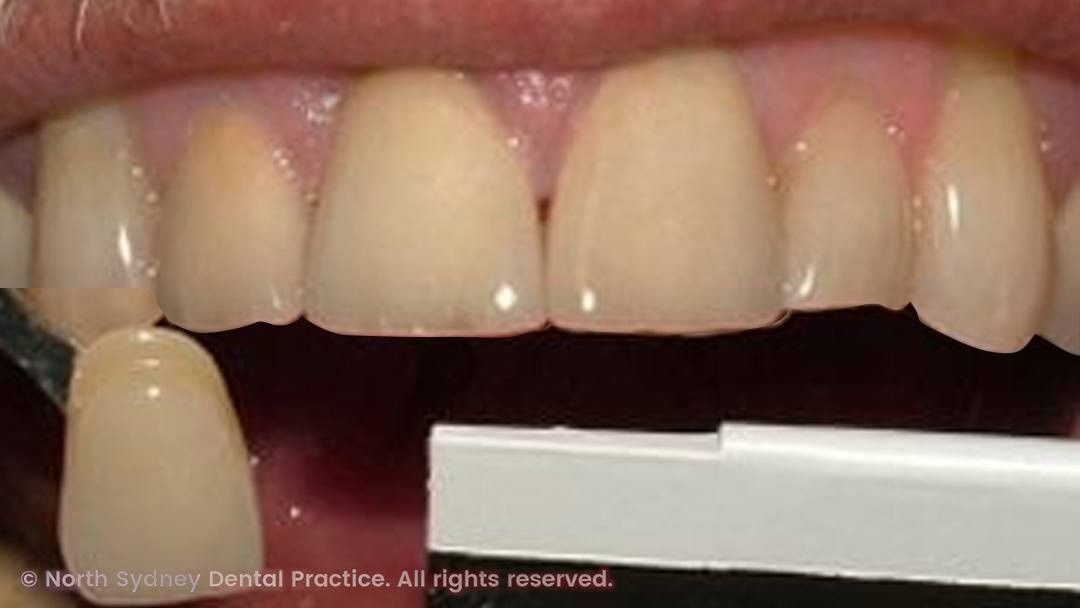 north-sydney-dental-practice-dental-crown-01