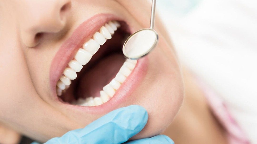 Dental Veneers vs Crowns or Implants
